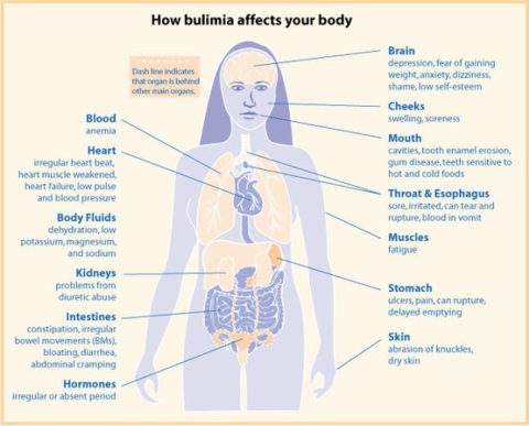 Consequences of Bulimia: Physical and psychological