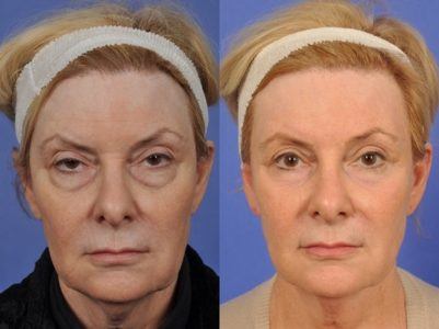 Blepharoplasty: what it is and recovery